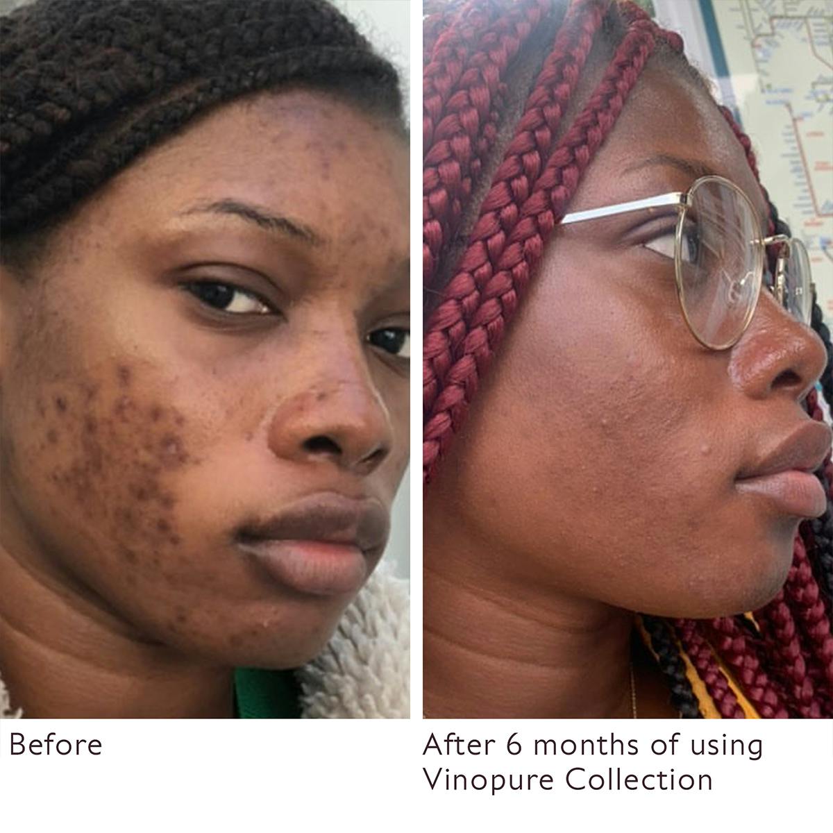 Natural Salicylic Acid Pore Minimizing Toner